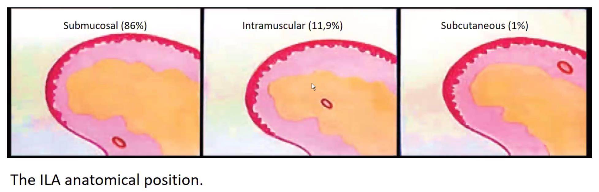 Lip anatomy and injection plane